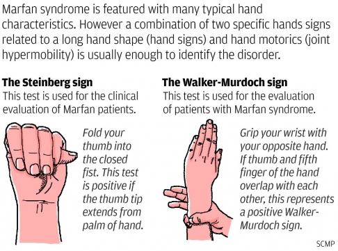 Do you know anyone who has Marfan Syndrome? | Tellwut.com