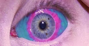 Eye Modification -- Injecting dye into your eyes is a popular body modification trend. People fill color into their eyes to change the color of their pupils to get some seriously unique eyes! Would you try this?