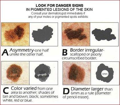 Regular skin exams by your doctor and yourself can help find cancers ...