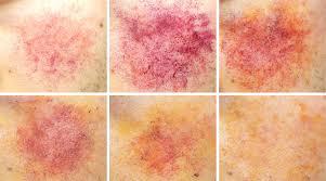 The stages and colors bruises | Tellwut.com