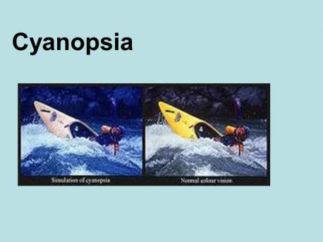 CYANOPSIA IS A MEDICAL CONDITION THAT CAUSES EVERYTHING YOU SEE TO APPEAR BLUE. CYANOPSIA (BLUE VISION) OFTEN OCCURS AFTER CATARACT SURGERY. THIS VISUAL ABNORMALITY IS USUALLY TEMPORARY. DO YOU KNOW ANYONE WHO HAS CYANOPSIA?