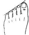 The condition can shift too much the weight to the second metatarsal, causing pain, callus formation and musculoskeletal problems. Surgical correction is sometimes used, but proper foot support is the treatment of first resort. Have you had to have surgery on your second toe because of the weight shift?